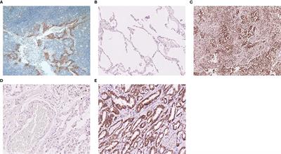 The Expression of Three Negative Co-Stimulatory B7 Family Molecules in Small Cell Lung Cancer and Their Effect on Prognosis